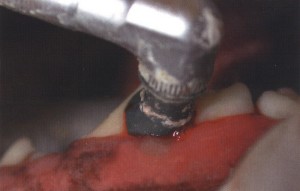 ליטוש שיניים לאחר הניקוי במרפאה