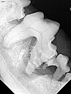 אובדן עצם מחלת חניכיים שיניים לעקירה